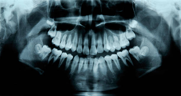 インプラントをすることが難しいケースとしては主に、インプラントを埋入予定の骨が適した厚みや形状ではない場合と、重度の歯周病から歯を失ってしまったケースです。